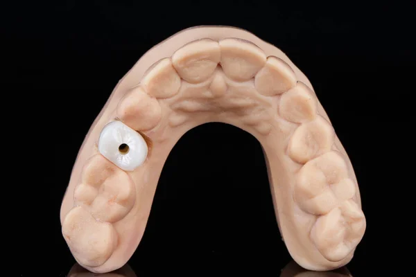Corona Dental Hecha Circón Modelo Dental Especial Para Ejecución Precisión —  Fotos de Stock