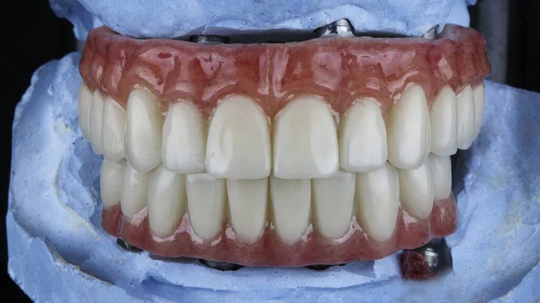 Δύο Οδοντιατρικές Προθέσεις Μια Ροζ Τσίχλα Στο Δάγκωμα Υψηλής Ποιότητας — Φωτογραφία Αρχείου