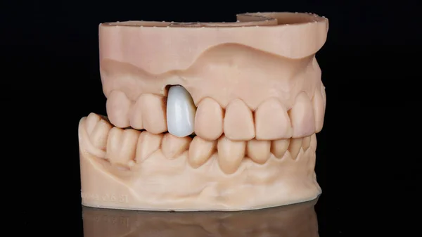 3Dプリンターで作られた特殊なモデルの歯冠は黒の背景で撮影され — ストック写真