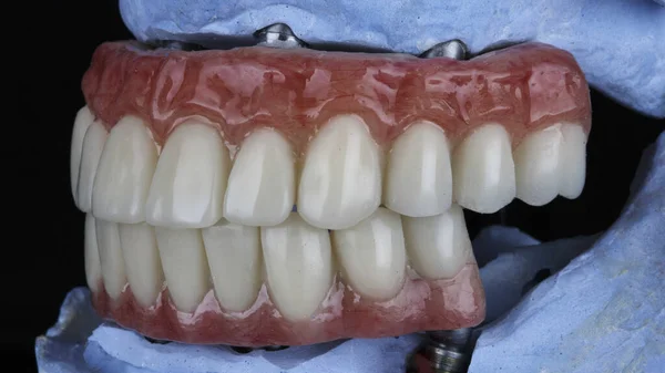 Due Protesi Dentali Con Una Gomma Rosa Nel Morso Installazione — Foto Stock