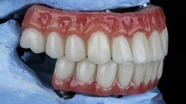 Próteses Dentárias Para Mandíbulas Inferior Superior Paciente Mordida Fundo Preto — Fotografia de Stock