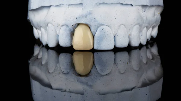 Korona Dentystyczna Zainstalowana Modelu Szczęki Gipsowej Czarnym Tle Odbiciem — Zdjęcie stockowe