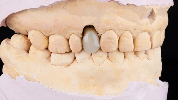 Coroa Dental Mais Alta Qualidade Modelo Gesso Filmado Fundo Preto — Fotografia de Stock