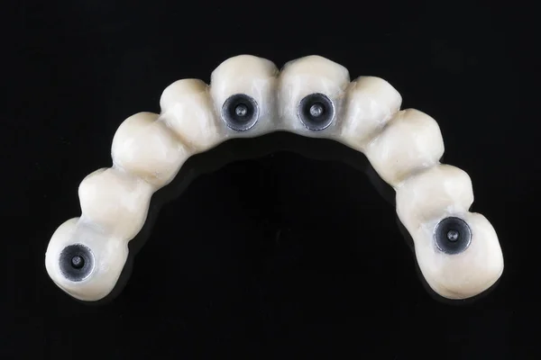 Prótesis Dental Mandíbula Superior Con Vistas Pieza Fijación Interna Con —  Fotos de Stock