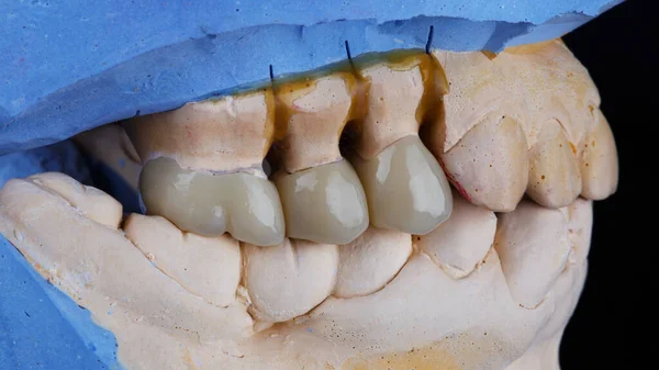 石膏模型の上に3つの歯冠 — ストック写真