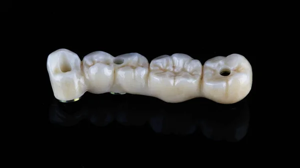 黒の背景で撮影された形態を持つ5本の歯の歯科用プロテーゼのマクロ写真 — ストック写真