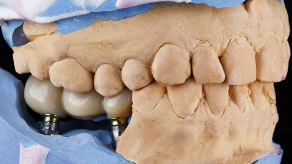 歯のモデルに黒い背景を持つ3本の噛む歯の大きな橋ではありません — ストック写真