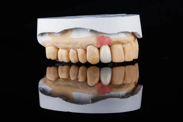 Dental Crown Made Zircon Mounted Model Gypsum Shot Black Glass — Stock Photo, Image