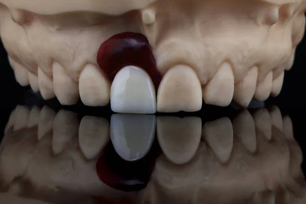 Modelo Dental Coroa Com Pedaço Tecido Mole Para Demonstrar Precisão — Fotografia de Stock