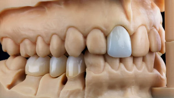 Μακροσκοπική Οδοντιατρική Φωτογραφία Μοντέλου Τρισδιάστατο Εκτυπωτή Και Κορώνες Από Ζιρκονία — Φωτογραφία Αρχείου