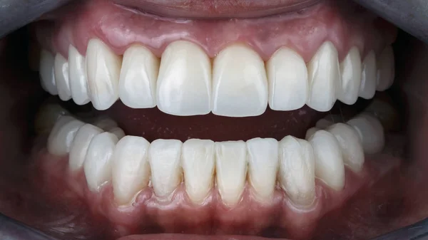 Uśmiech Ceramicznymi Okleinami Fotografia Stomatologiczna — Zdjęcie stockowe