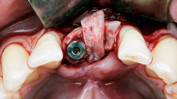 Adição Partes Moles Mandíbula Inferior Para Volume Goma Após Implantação — Fotografia de Stock