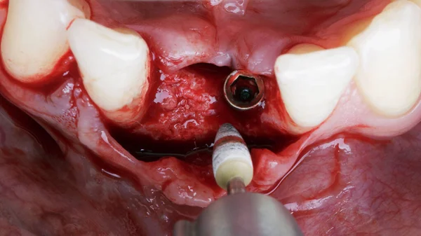Specjalny Przyrząd Dentystyczny Przygotowywania Kości Szczęki Dolnej Implantacji — Zdjęcie stockowe