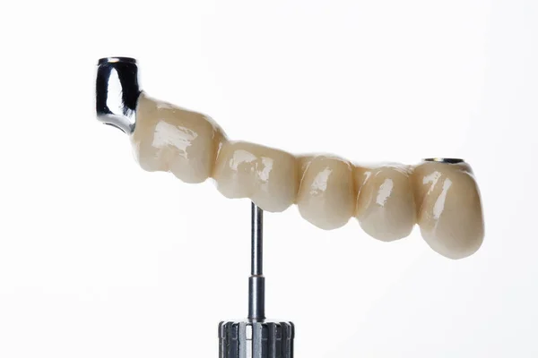 Зубний Міст Титановому Брусі Коронами Зубів Зоні Жування Знятий Білому — стокове фото