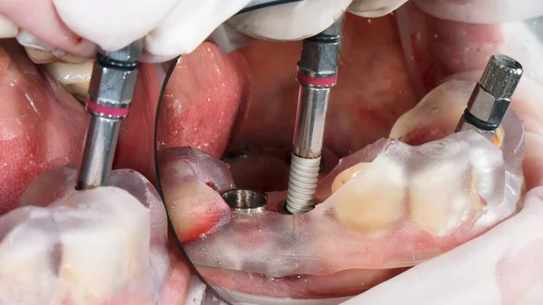 Cerrahi Şablon Vasıtasıyla Yüksek Kaliteli Bir Implant Yerleştirilmiş — Stok fotoğraf