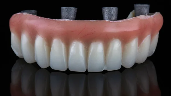 Prótese Dentária Temporária Mandíbula Inferior Para Carregamento Após Implantação Filmada — Fotografia de Stock