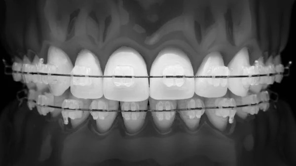 Excelente Fotografia Dental Modelo Mandíbulas Com Aparelho Estilo Preto Branco — Fotografia de Stock