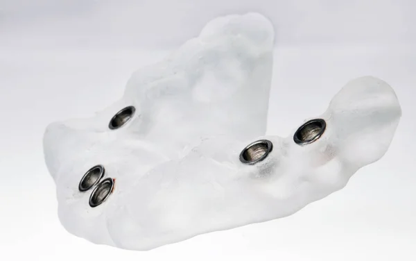Ottima Foto Macro Modello Impianto Dentale Cinque Impianti Dentali Composizione — Foto Stock