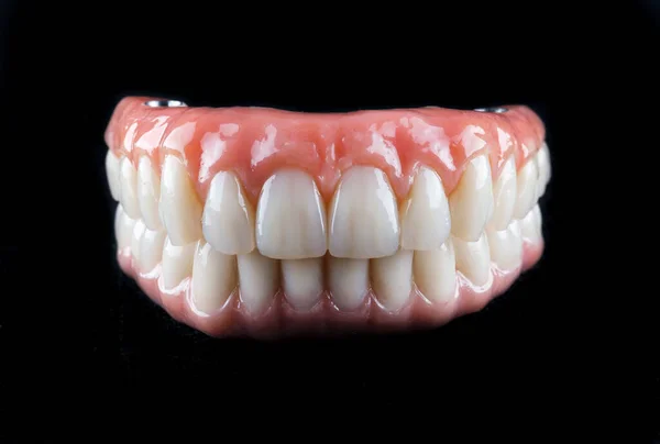 黒い背景の下顎と上顎の金属製セラミック入れ歯 — ストック写真