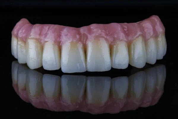 Prótese Dentária Muito Excelente Com Goma Rosa Para Mandíbula Superior — Fotografia de Stock