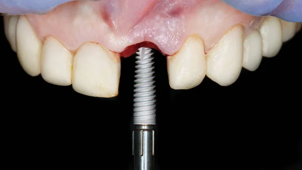 Implante Dentário Antes Instalação Mandíbula Superior Paciente Para Restaurar Dente — Fotografia de Stock