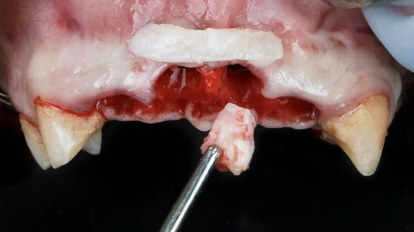 Soft Tissue Flaps Restore Gum Volume Implantation — Stock Photo, Image