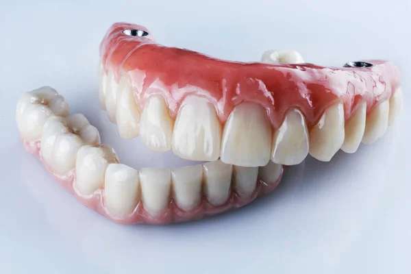 白い背景に4本のインプラントを固定するための上顎と下顎のセラミック歯科入れ歯 — ストック写真