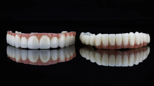 インプラント後の患者の上顎と下顎に固定するための2つの高品質の歯科用義歯 — ストック写真