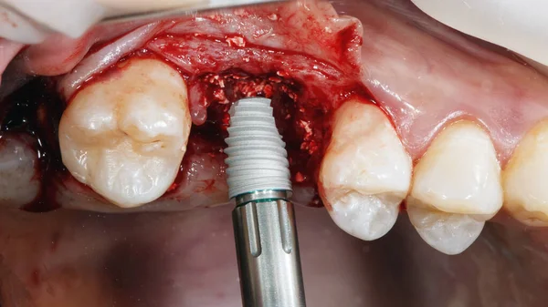 Implantation Avec Ajout Artificiel Dans Cavité Gingivale Patient — Photo