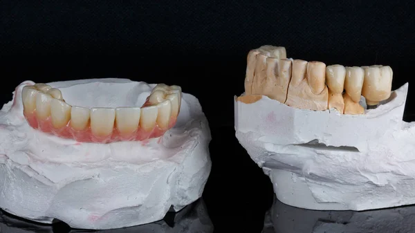 Prótesis Dental Hecha Cerámica Coronas Modelo Yeso —  Fotos de Stock
