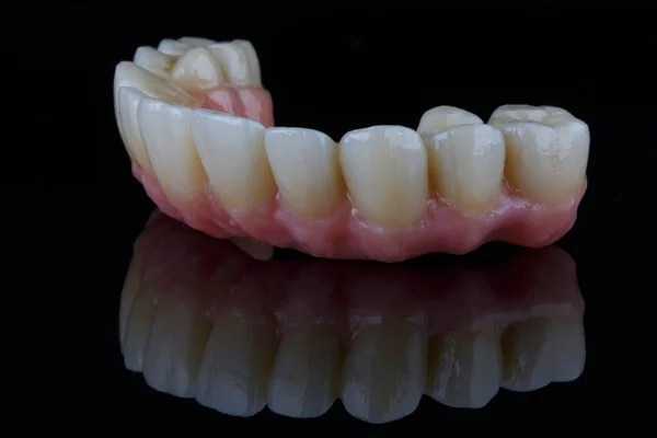 Bardzo Piękna Proteza Protezy Zębowej Różową Gumą Górnej Szczęki Nakręcona — Zdjęcie stockowe