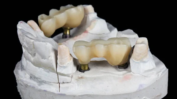 Base Para Coroas Dentárias Pontes Mastigação Vista Lateral Sobre Fundo — Fotografia de Stock