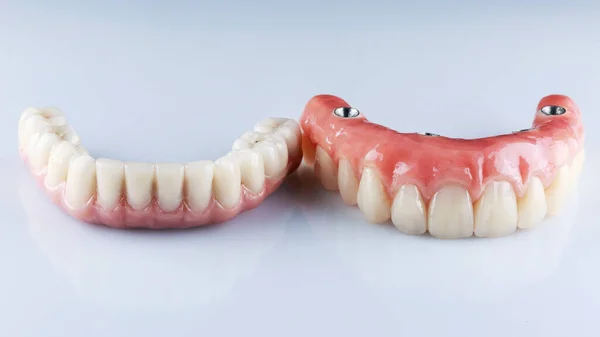 Próteses Dentárias Prontas Para Inserção Permanente Filmadas Fundo Branco — Fotografia de Stock