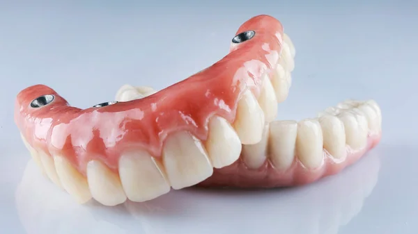 白い背景に歯科用義歯を4本のインプラントに固定し — ストック写真