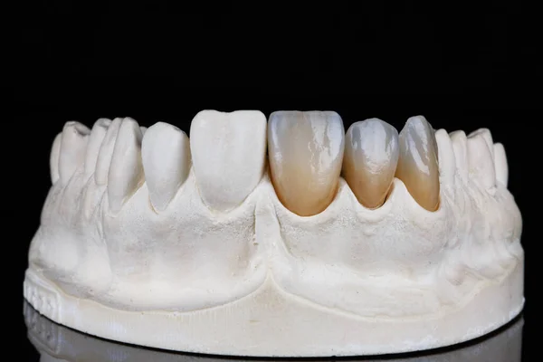 黒を背景に撮影された特殊なモデルで高品質で自然な色の歯科用ベンチャー — ストック写真