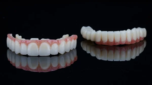 Próteses Dentárias Temporárias Para Mandíbula Superior Inferior Doente Após Implantação — Fotografia de Stock