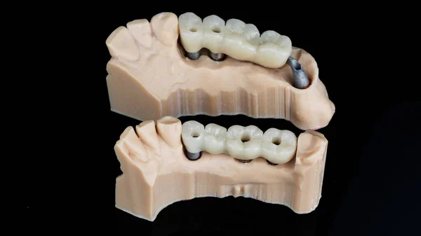 Puentes Dentales Temporales Para Masticar Dientes Con Modelos Barras —  Fotos de Stock