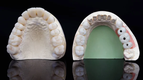 歯の美しい形態を持つ歯のベンチャーと冠は 創造的な反射と黒の背景に — ストック写真