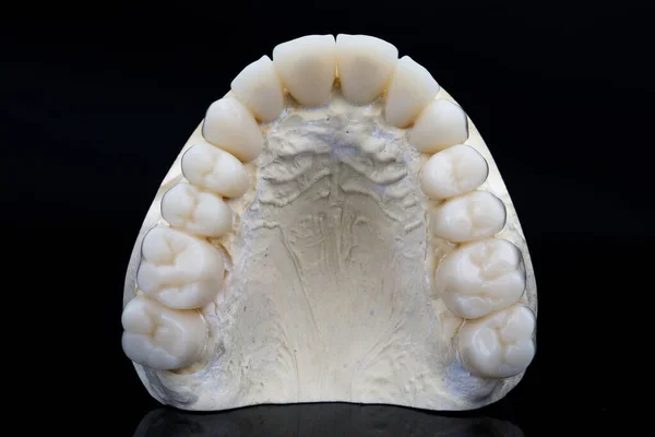 Coroas Dentárias Temporárias Folheados Plástico Para Uso Temporário Retirados Cima — Fotografia de Stock