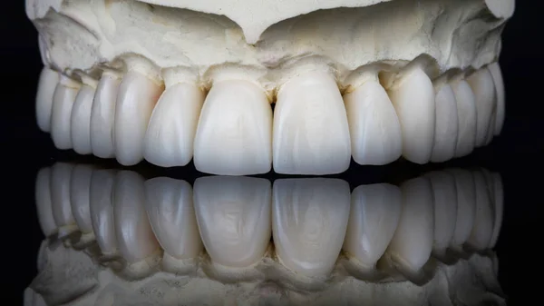 樹脂製の一時的な歯科用ベンダーで 一時的に着用するために ガラスに美しい反射と黒の背景に上から撮影しました — ストック写真