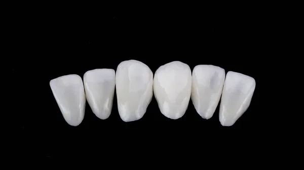 Ceramiczne Okleiny Dentystyczne Określone Składzie Dolnej Szczęki Siekaczy Centralnych Czarnym — Zdjęcie stockowe