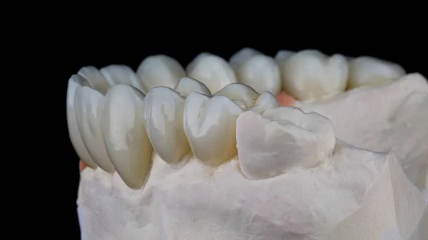 黒の背景で撮影された石膏モデルの美しい歯科ベンチャーと冠 — ストック写真