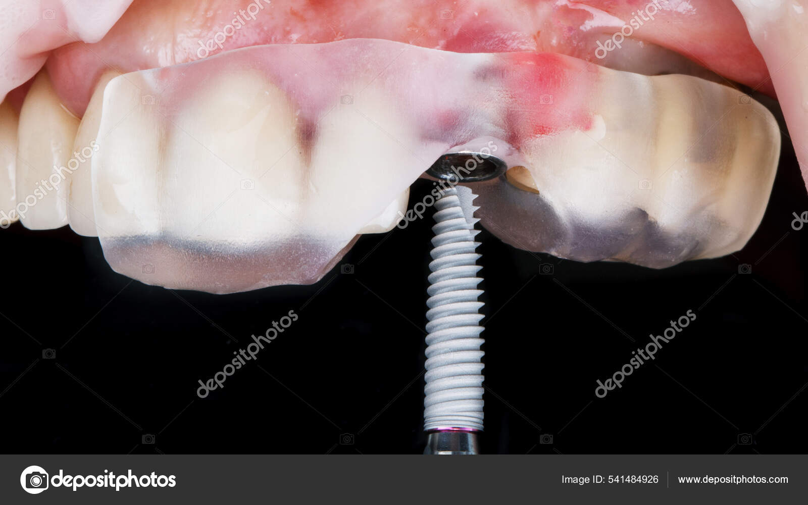 Dental Implant Insertion Surgical Template Accuracy Stock Photo by ©dendorstock 541484926