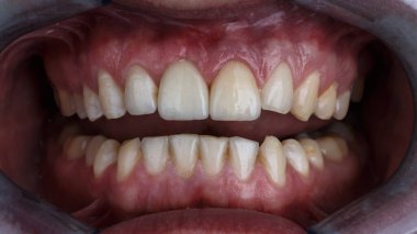 Başarılı implantasyondan ve sağlıklı diş etlerinden sonra ön dişlerinde zirkon kaplaması.