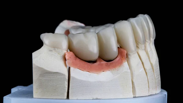 Korona Dentystyczna Sztuczną Gumą Modelu Dolnej Szczęki Czarnym Tle — Zdjęcie stockowe