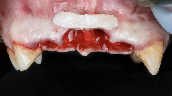 Toevoeging Van Een Zachte Weefselflap Tijdens Implantatie Van Centrale Tanden — Stockfoto