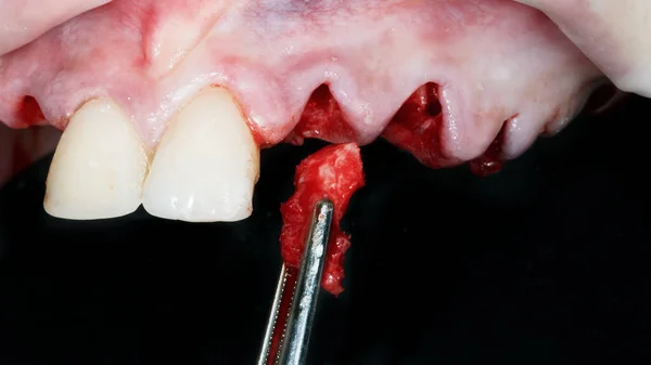 Knochenfragmente Vor Dem Hinzufügen Während Der Implantation Und Komplexen Zahnärztlichen — Stockfoto