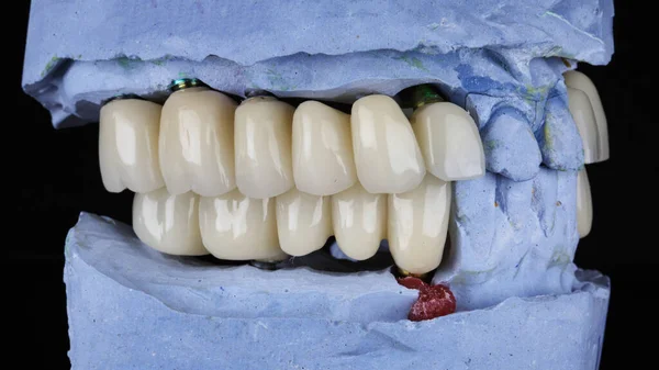 ほとんど全ての顎にセラミック製の義歯があり — ストック写真