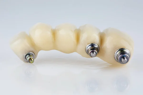 Piękna Kompozycja Mostu Dentystycznego Pięć Zębów Metalową Belką Zapewniającą Ogólną — Zdjęcie stockowe