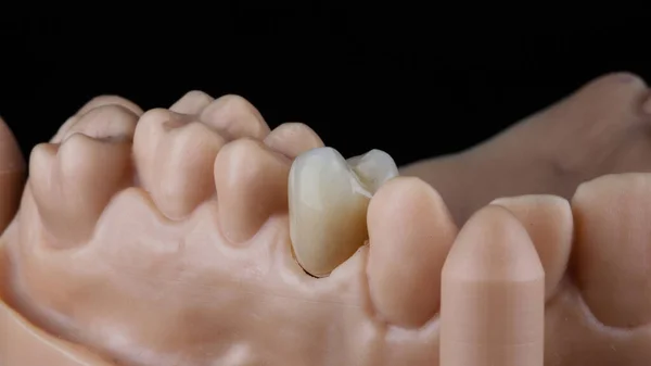 Οδοντιατρική Στεφάνη Δοντιού Μασήματος Από Κεραμικό Ειδικό Μοντέλο — Φωτογραφία Αρχείου